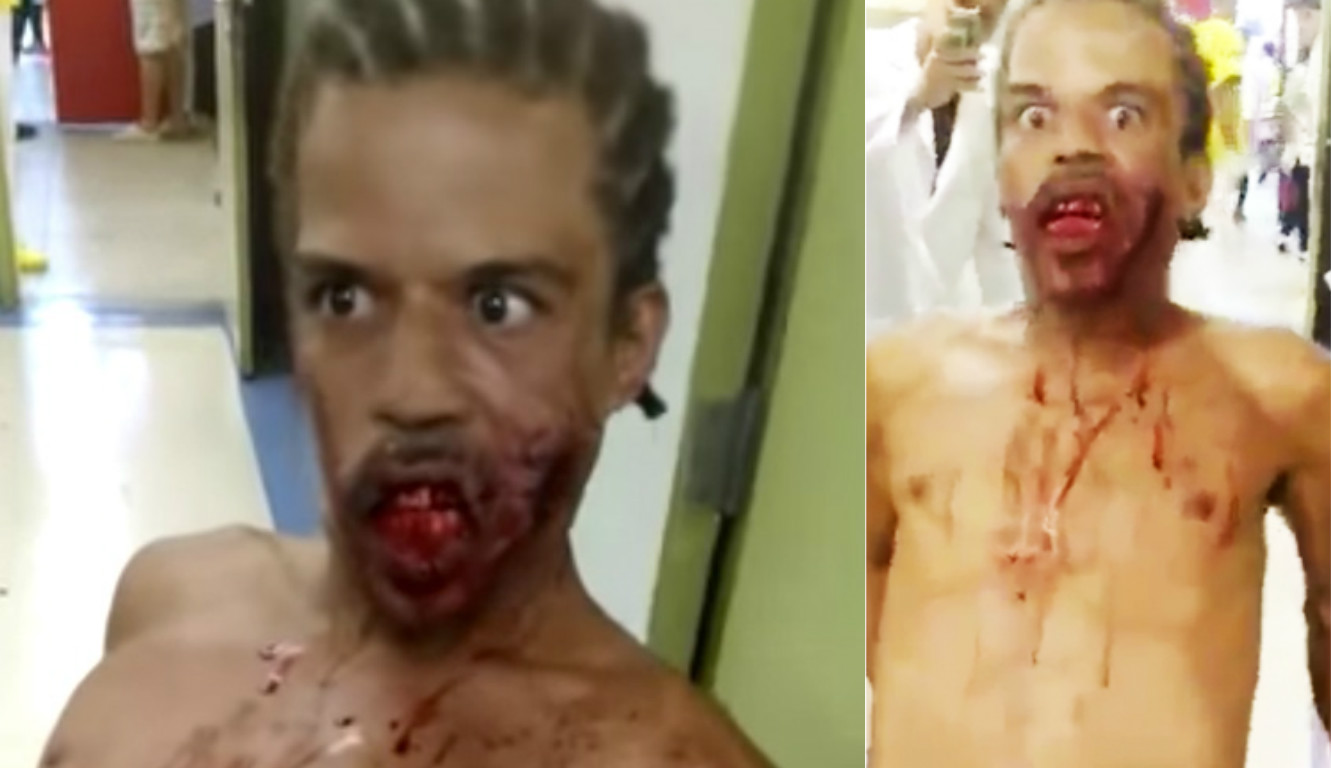 Terrifying Footage Shows ‘Zombie Man’ In Hospital After Being Shot In The Face