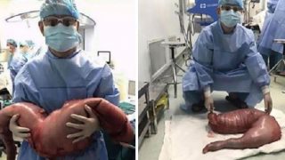 Surgeons Removed This From A Man Who Had Been Constipated For Years