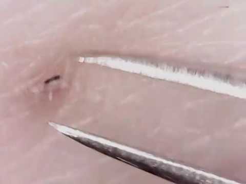 Extreme Close Ups of In-Grown Hair Removal Are Very “Satisfying”