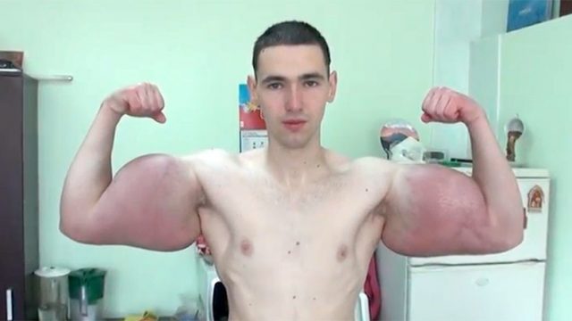 Bloke Shows Off Brand New Synthol-Enlarged Biceps