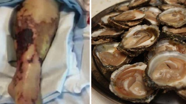 Woman Killed From Flesh-Eating Bacteria After Eating 24 Raw Oysters