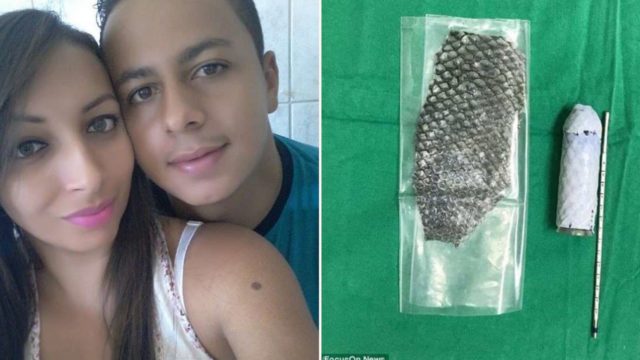 Woman, 23, born without a vagina has one made out of fish skin in historic operation