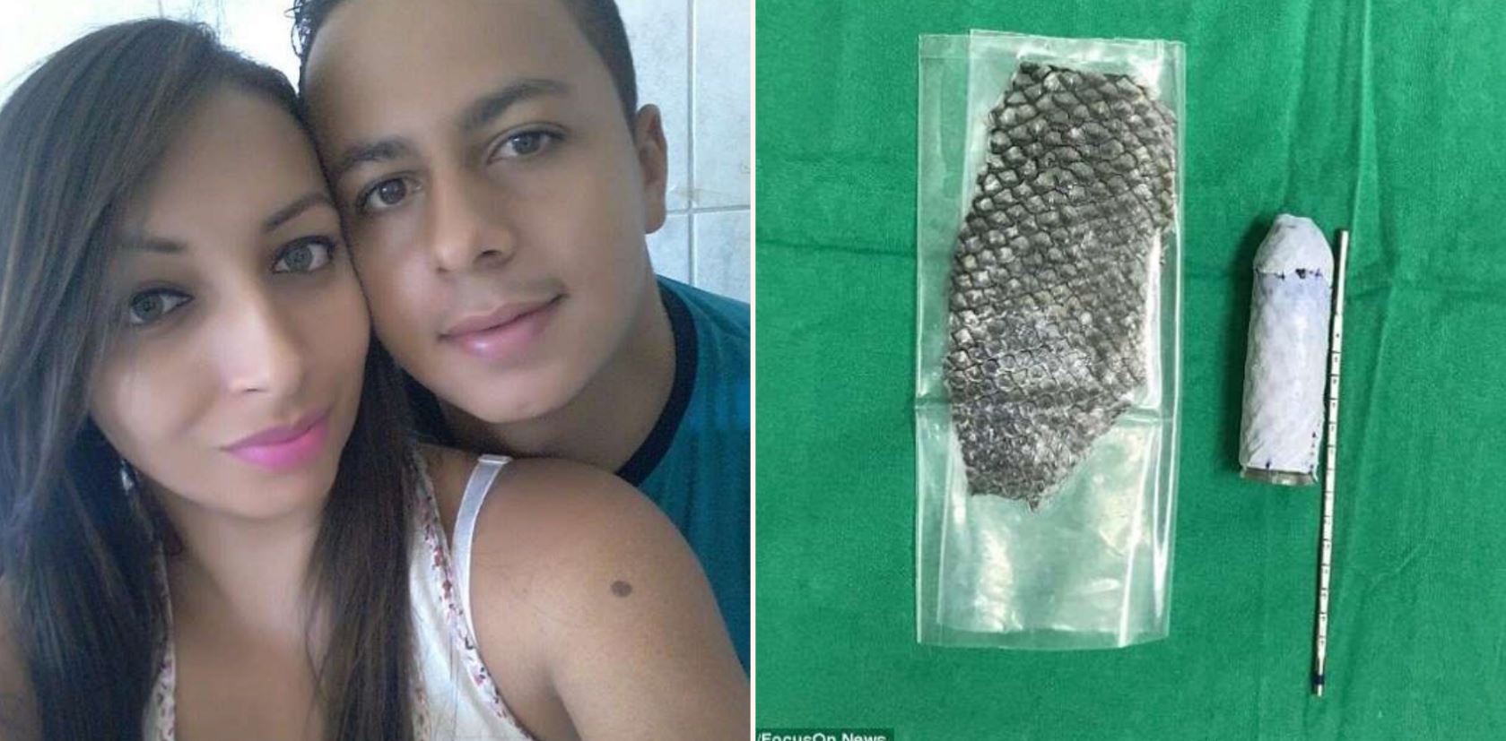 Woman, 23, born without a vagina has one made out of fish skin in historic operation