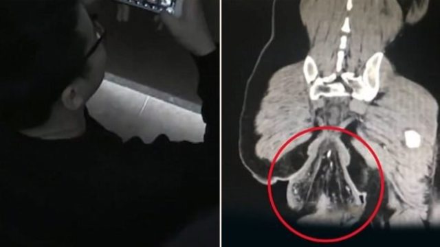 Man’s ass falls out after sitting on the toilet too long playing games on his phone