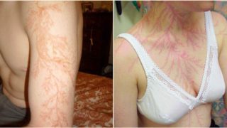 Some lucky bastards who survived lightning strikes have shown what it does to your skin