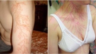 Some lucky bastards who survived lightning strikes have shown what it does to your skin
