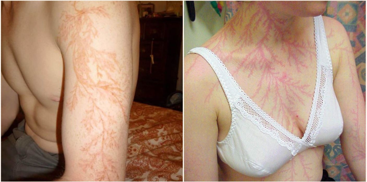 Some lucky bastards who survived lightning strikes have shown what it does to your skin