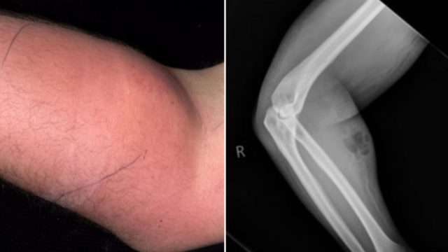 Bloke ends up in hospital after injecting semen to cure back pain