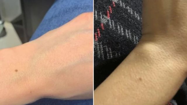 Turns out everyone has the same freckle and they’re freaking out