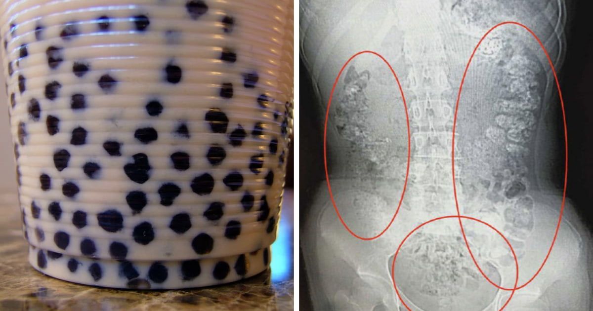 Teen in China allegedly has 100+ undigested bubble tea pearls inside her