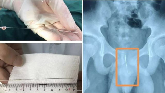 Chinese kid sticks needle in his wanger to ‘keep himself awake’