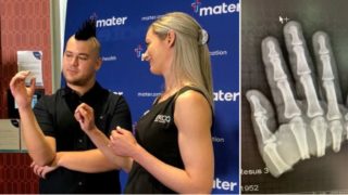 Bloke who chopped half his hand off could wiggle it just days later after surgery