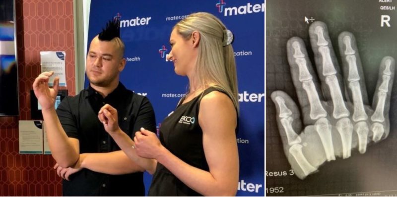 Bloke who chopped half his hand off could wiggle it just days later after surgery