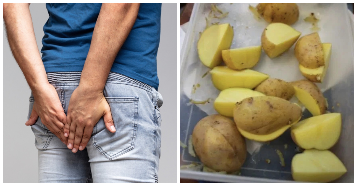 Doctors are warning people to not put frozen potatoes in their anus