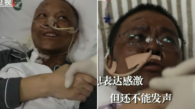 Chinese Doctors’ skin turned dark after Covid-19 recovery