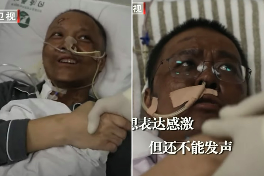 Chinese Doctors’ skin turned dark after Covid-19 recovery