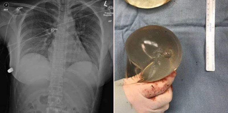 Sheila’s implant saves her life in what appears to be a medical first