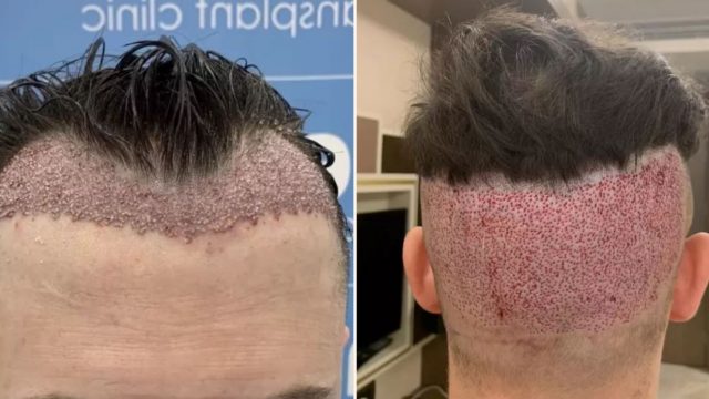 UK man shares the results of his cut price hair transplant