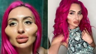Sheila with extreme cheek-fillers reckons she’s getting more blokes than ever before