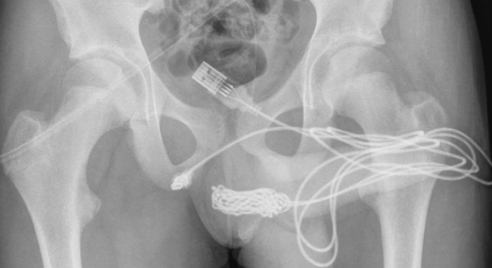 Teen gets USB cable stuck in urethra