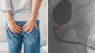 Rare condition causes bloke to poo from his penis and ejaculate semen from his butt