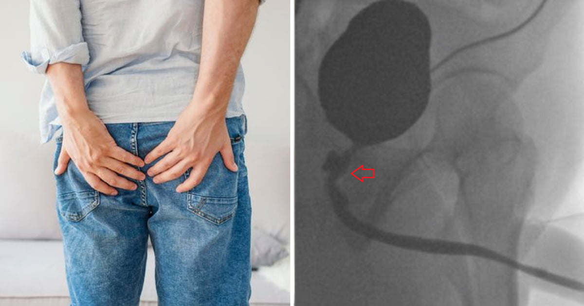 Rare condition causes bloke to poo from his penis and ejaculate semen from his butt