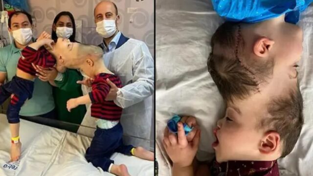 Conjoined twins with fused brains successfully separated in ‘space-age’ surgery!